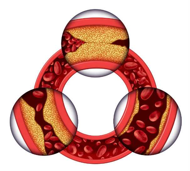 Clogged Artery Model, English-Spanish